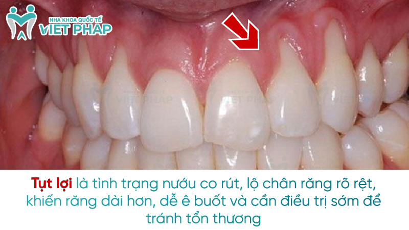 Tụt lợi là tình trạng nướu co rút, lộ chân răng rõ rệt, khiến răng dài hơn, dễ ê buốt và cần điều trị sớm để tránh tổn thương