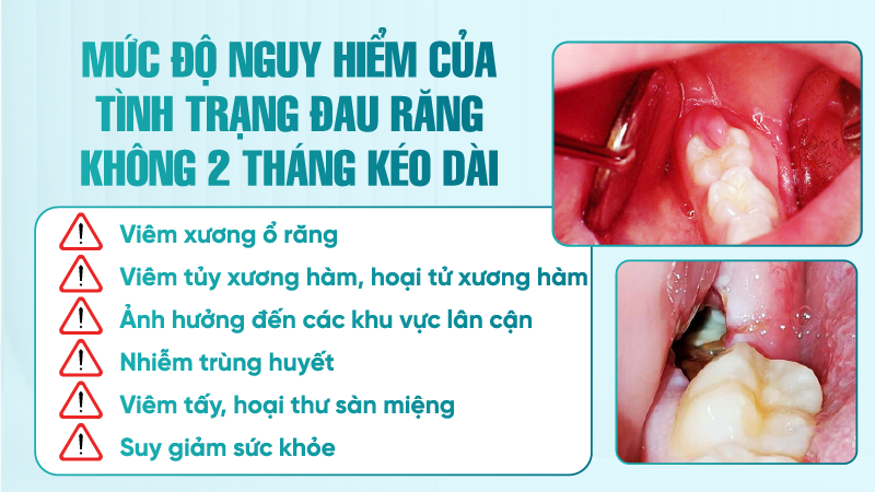 Mức độ nguy hiểm của tình trạng đau răng không 2 tháng kéo dài
