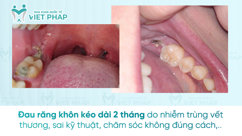 Đau răng khôn kéo dài 2 tháng do nhiễm trùng vết thương, sai kỹ thuật, chăm sóc không đúng cách,..