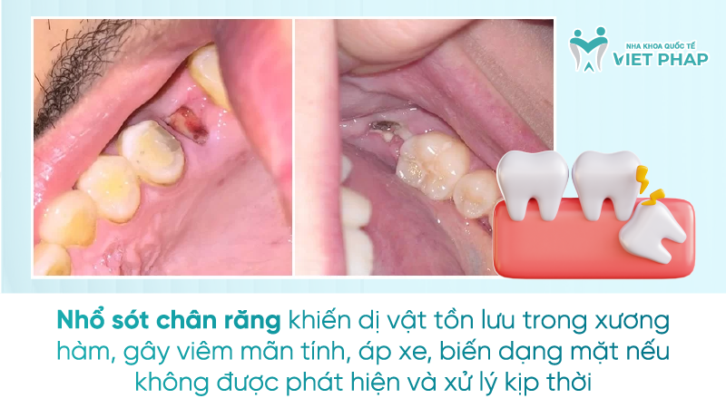 Nhổ sót chân răng khiến dị vật tồn lưu trong xương hàm, gây viêm mãn tính, áp xe, biến dạng mặt nếu không được phát hiện và xử lý kịp thời