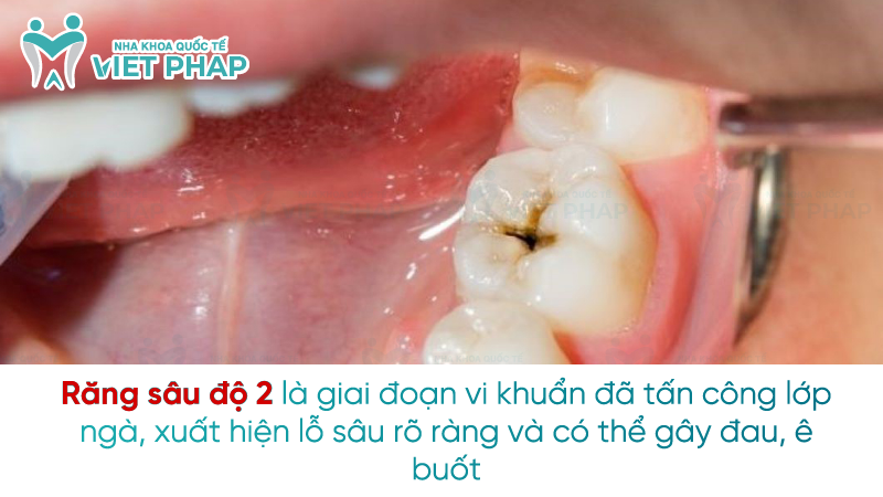Rang sau do 2 la nhu the nao 1 Răng sâu độ 2 là giai đoạn vi khuẩn đã tấn công lớp ngà, xuất hiện lỗ sâu rõ ràng và có thể gây đau, ê buốt