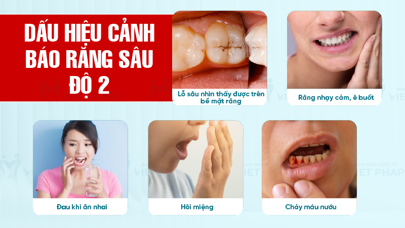 Rang sau do 2 la nhu the nao 2 Dấu hiệu cảnh báo răng sâu độ 2