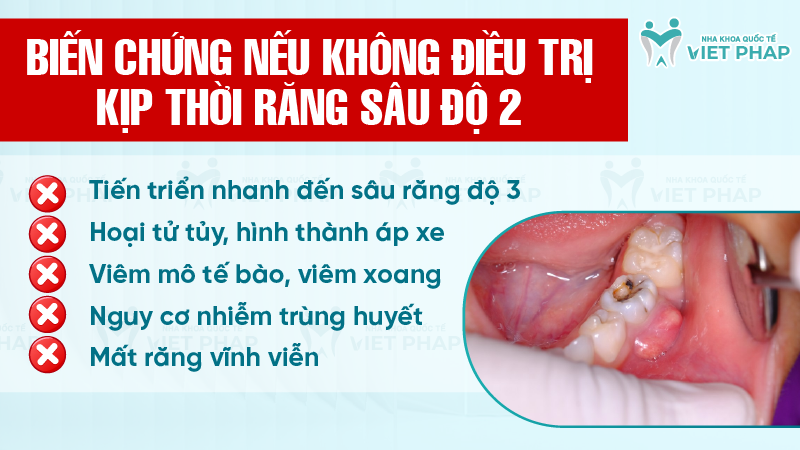 Rang sau do 2 la nhu the nao 7 Biến chứng nếu không điều trị kịp thời răng sâu độ 2