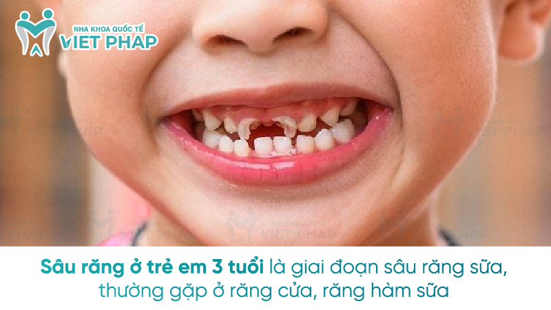 Sâu răng ở trẻ em 3 tuổi là giai đoạn sâu răng sữa, thường gặp ở răng cửa, răng hàm sữa