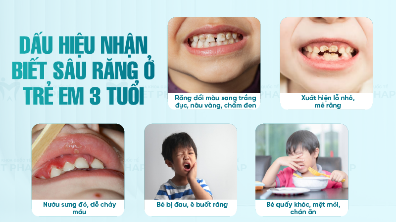 Dấu hiệu nhận biết sâu răng ở trẻ em 3 tuổi