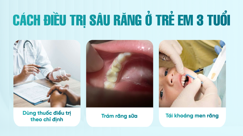 Cách điều trị sâu răng ở trẻ em 3 tuổi