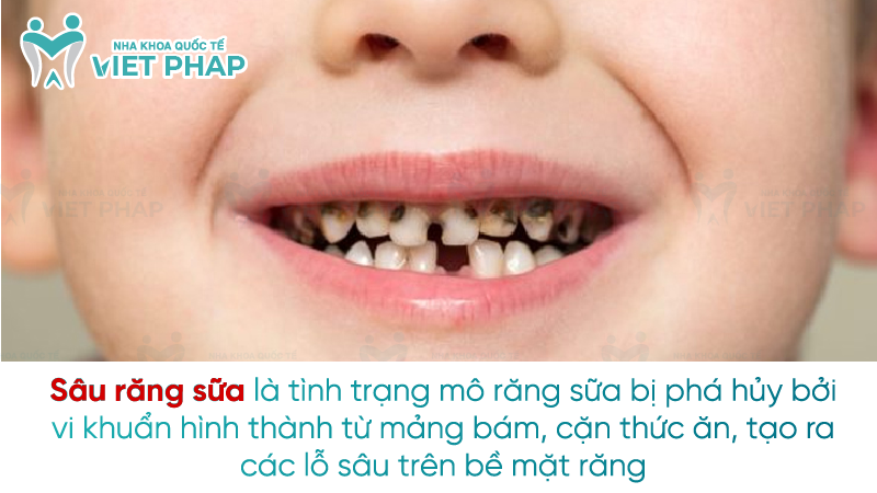 Sau rang sua 1 Sâu răng sữa là tình trạng mô răng sữa bị phá hủy bởi vi khuẩn hình thành từ mảng bám, cặn thức ăn, tạo ra các lỗ sâu trên bề mặt răng