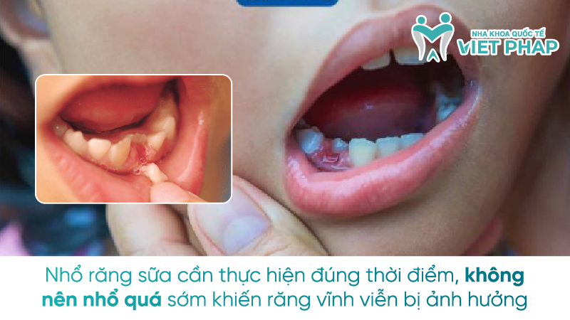 Sau rang sua 10 Nhổ răng sữa cần thực hiện đúng thời điểm, không nên nhổ quá sớm khiến răng vĩnh viễn bị ảnh hưởng