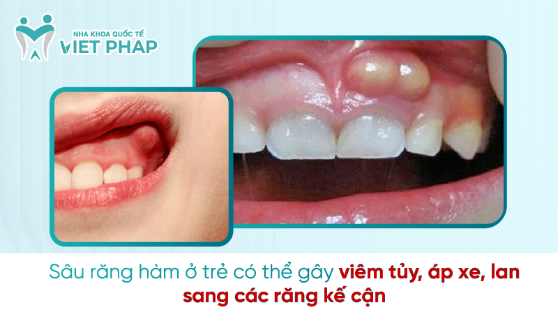 Sau rang sua 12 Sâu răng hàm ở trẻ có thể gây viêm tủy, áp xe, lan sang các răng kế cận