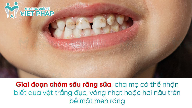 Sau rang sua 2 Giai đoạn chớm sâu răng sữa, cha mẹ có thể nhận biết qua vệt trắng đục, vàng nhạt hoặc hơi nâu trên bề mặt men răng