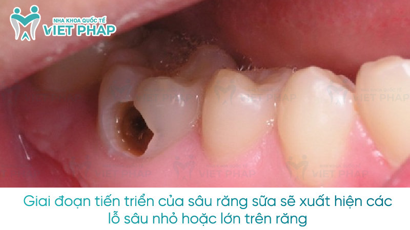 Sau rang sua 3 Giai đoạn tiến triển của sâu răng sữa sẽ xuất hiện các lỗ sâu nhỏ hoặc lớn trên răng