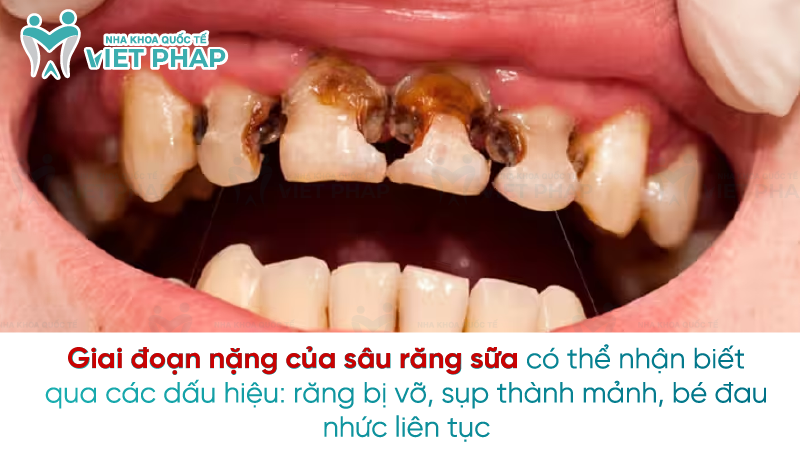 Sau rang sua 4 Giai đoạn nặng của sâu răng sữa có thể nhận biết qua các dấu hiệu: răng bị vỡ, sụp thành mảnh, bé đau nhức liên tục