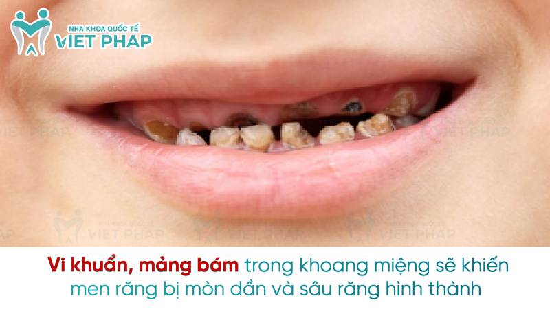 Sau rang sua 5 Vi khuẩn, mảng bám trong khoang miệng sẽ khiến men răng bị mòn dần và sâu răng hình thành