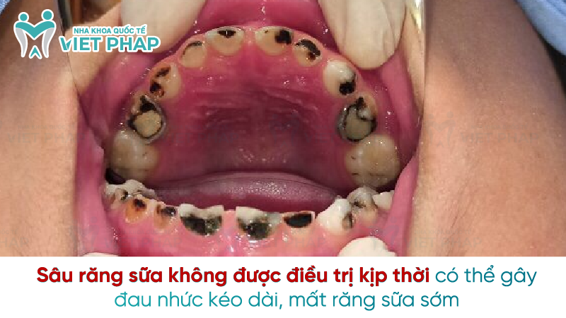 Sau rang sua 7 Sâu răng sữa không được điều trị kịp thời có thể gây đau nhức kéo dài, mất răng sữa sớm
