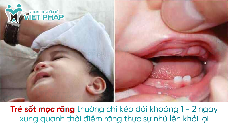 Sot moc rang 1 Trẻ sốt mọc răng thường chỉ kéo dài khoảng 1 - 2 ngày xung quanh thời điểm răng thực sự nhú lên khỏi lợi