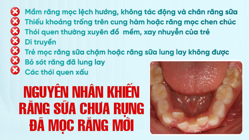 Tai sao rang sua chua rung da moc rang moi 3 Nguyên nhân khiến răng sữa chưa rụng đã mọc răng mới