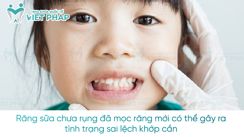 Tai sao rang sua chua rung da moc rang moi 4 Răng sữa chưa rụng đã mọc răng mới có thể gây ra tình trạng sai lệch khớp cắn