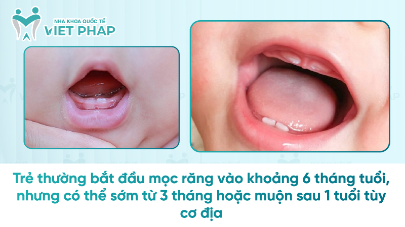 Tre em may thang moc rang 1 Trẻ thường bắt đầu mọc răng vào khoảng 6 tháng tuổi, nhưng có thể sớm từ 3 tháng hoặc muộn sau 1 tuổi tùy cơ địa