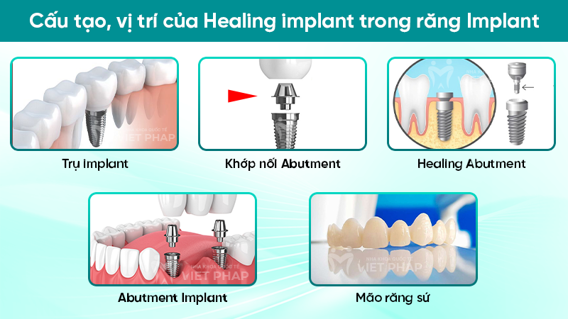 Cấu tạo, vị trí của Healing implant trong răng Implant