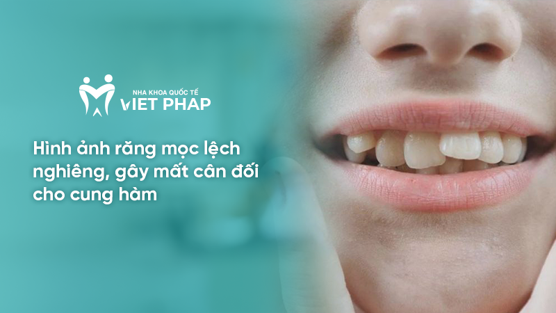 hinh anh rang moc lech 1.2 Hình ảnh răng mọc lệch nghiêng, gây mất cân đối cho cung hàm