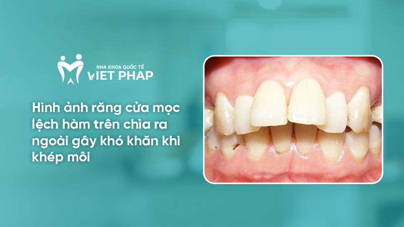 hinh anh rang moc lech 1.4 Hình ảnh răng cửa mọc lệch hàm trên chìa ra ngoài gây khó khăn khi khép môi
