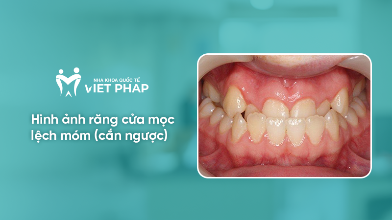 hinh anh rang moc lech 1.5 Hình ảnh răng cửa mọc lệch móm (cắn ngược)