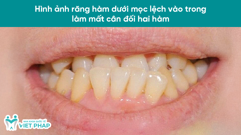 hinh anh rang moc lech 2 Hình ảnh răng hàm dưới mọc lệch vào trong làm mất cân đối hai hàm