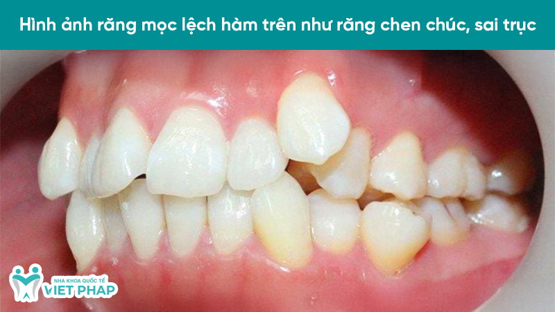 hinh anh rang moc lech 3 Hình ảnh răng mọc lệch hàm trên như răng chen chúc, sai trục