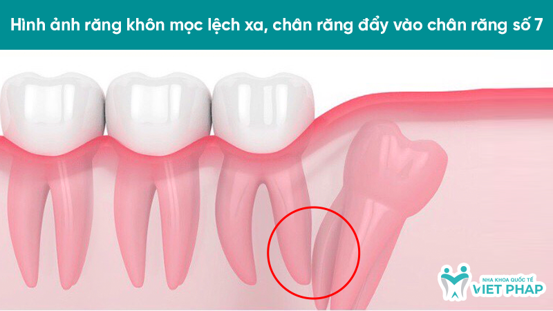 hinh anh rang moc lech 4.2 Hình ảnh răng khôn mọc lệch xa, chân răng đẩy vào chân răng số 7