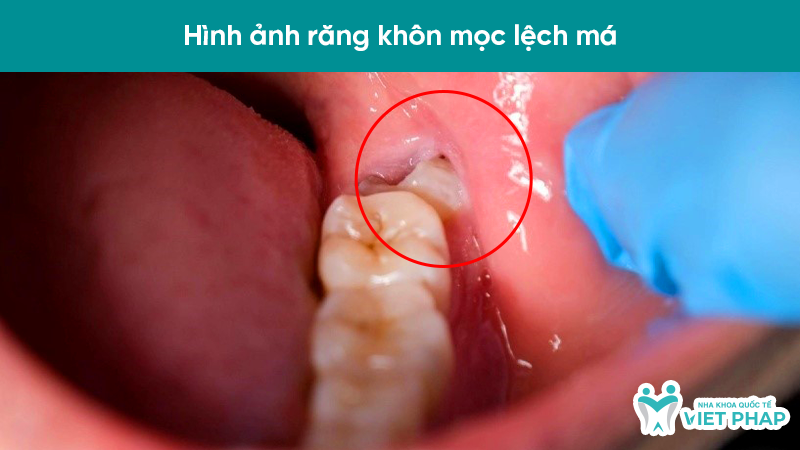 hinh anh rang moc lech 4.3 Hình ảnh răng khôn mọc lệch má
