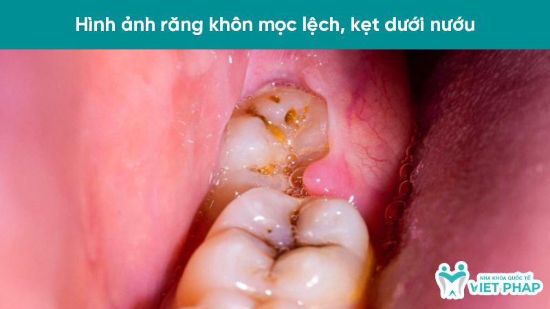hinh anh rang moc lech 4.5 Hình ảnh răng khôn mọc lệch, kẹt dưới nướu