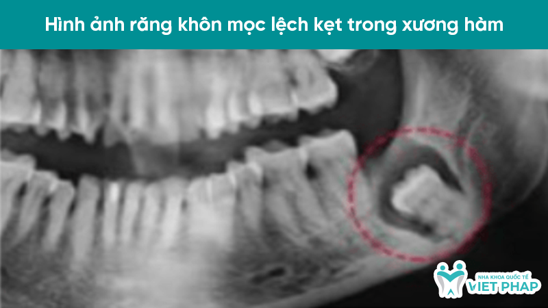 hinh anh rang moc lech 4.6 Hình ảnh răng khôn mọc lệch kẹt trong xương hàm