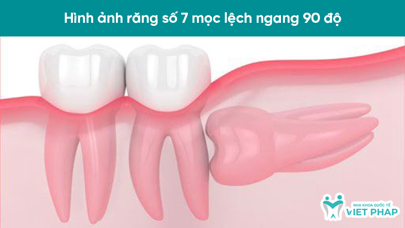 hinh anh rang moc lech 5 Hình ảnh răng số 7 mọc lệch ngang 90 độ