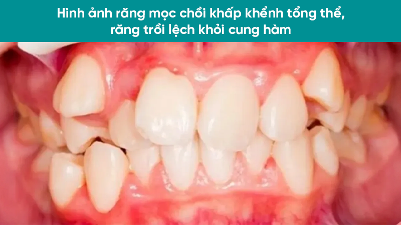 hinh anh rang moc lech 6 Hình ảnh răng mọc chồi khấp khểnh tổng thể, răng trồi lệch khỏi cung hàm