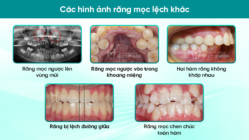 hinh anh rang moc lech 7 Các hình ảnh răng mọc lệch khác