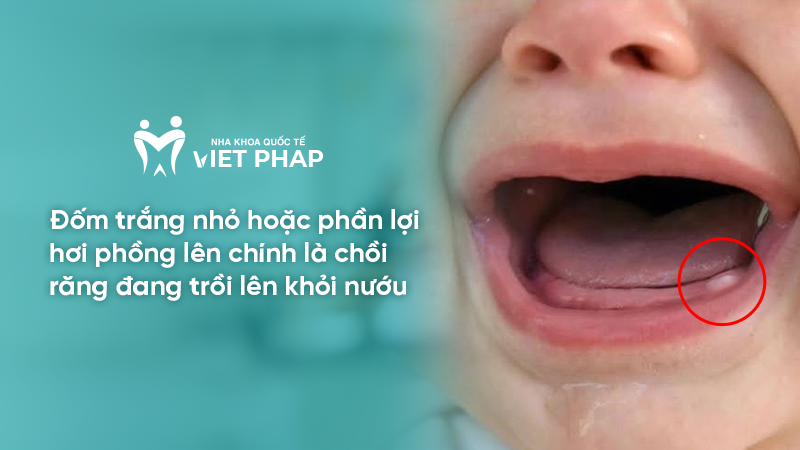 hinh anh tre sap moc rang ham 1.2 Đốm trắng nhỏ hoặc phần lợi hơi phồng lên chính là chồi răng đang trồi lên khỏi nướu