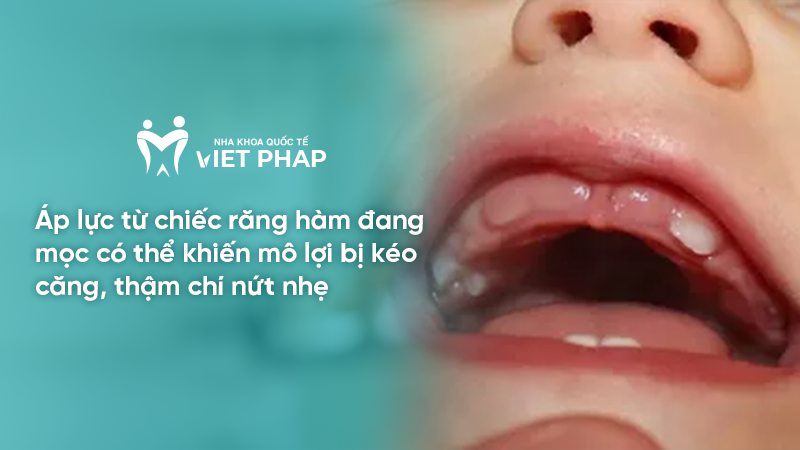 hinh anh tre sap moc rang ham 1.3 Áp lực từ chiếc răng hàm đang mọc có thể khiến mô lợi bị kéo căng, thậm chí nứt nhẹ