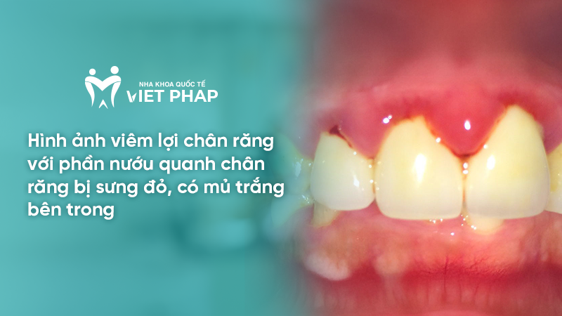 Hình ảnh viêm lợi chân răng với phần nướu quanh chân răng bị sưng đỏ, có mủ trắng bên trong