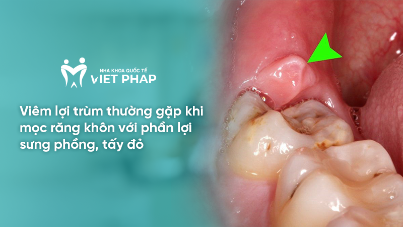 Viêm lợi trùm thường gặp khi mọc răng khôn với phần lợi sưng phồng, tấy đỏ