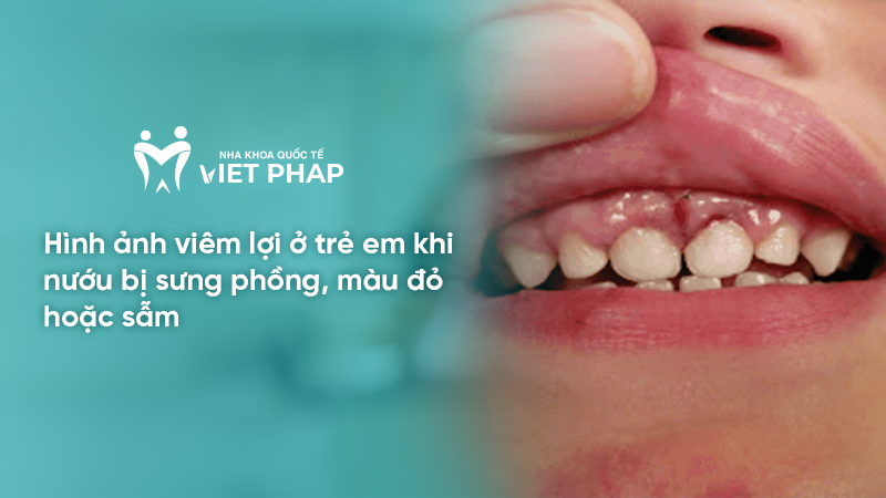 Hình ảnh viêm lợi ở trẻ em khi nướu bị sưng phồng, màu đỏ hoặc sẫm