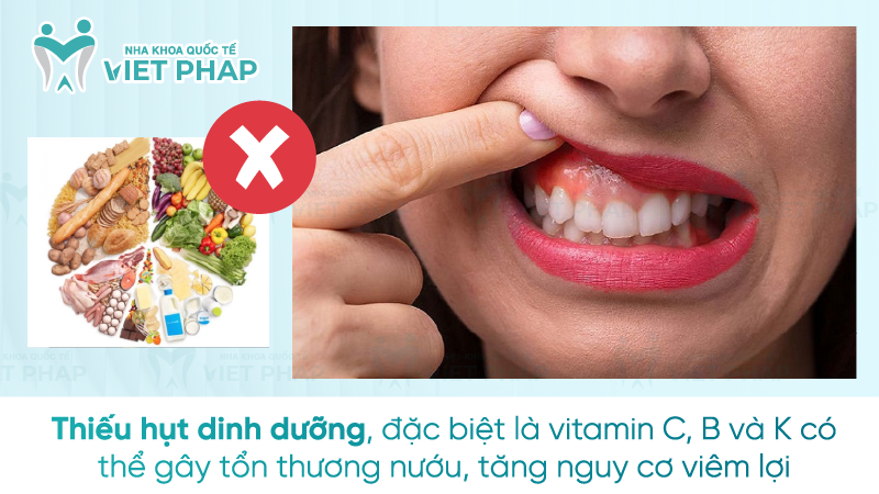 Thiếu hụt dinh dưỡng, đặc biệt là vitamin C, B và K có thể gây tổn thương nướu, tăng nguy cơ viêm lợi