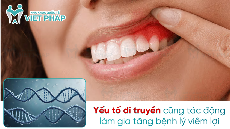 Yếu tố di truyền cũng tác động làm gia tăng bệnh lý viêm lợi