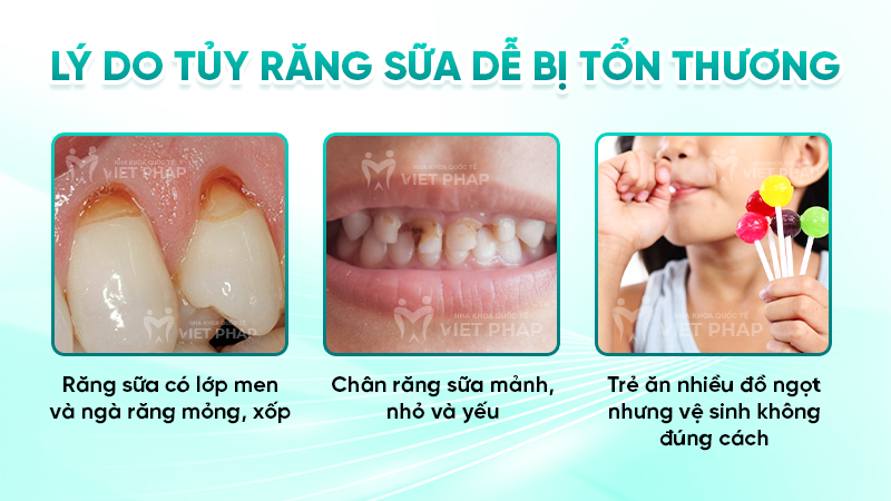 rang sua co tuy khong 2 Lý do tủy răng sữa dễ bị tổn thương