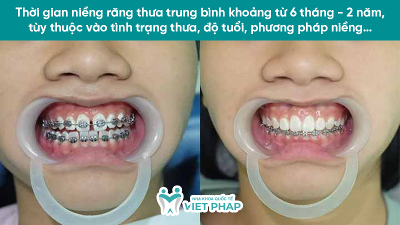 Thời gian niềng răng thưa trung bình khoảng từ 6 tháng - 2 năm, tùy thuộc vào tình trạng thưa, độ tuổi, phương pháp niềng…