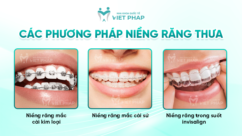 Các phương pháp niềng răng thưa