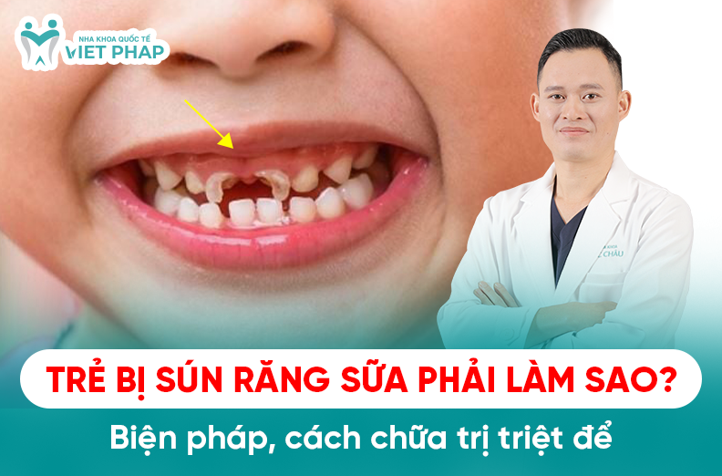 Trẻ bị sún răng sữa phải làm sao? Biện pháp, cách chữa trị triệt để