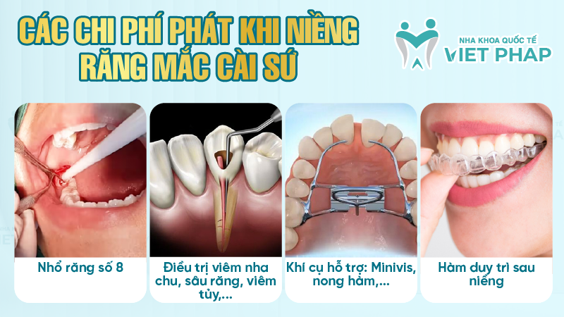 Bang gia nieng rang mac cai su 4 Các chi phí phát khi niềng răng mắc cài sứ