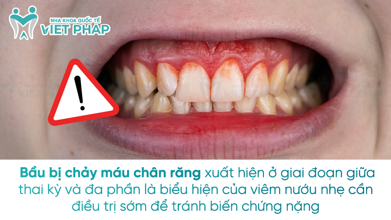 Bau bi chay mau chan rang 1 Bầu bị chảy máu chân răng xuất hiện ở giai đoạn giữa thai kỳ và đa phần là biểu hiện của viêm nướu nhẹ cần điều trị sớm để tránh biến chứng nặng