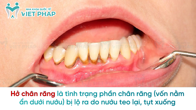 Hở chân răng là tình trạng phần chân răng (vốn nằm ẩn dưới nướu) bị lộ ra do nướu teo lại, tụt xuống