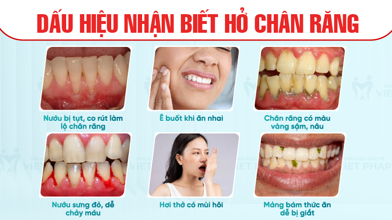 Dấu hiệu nhận biết hở chân răng 